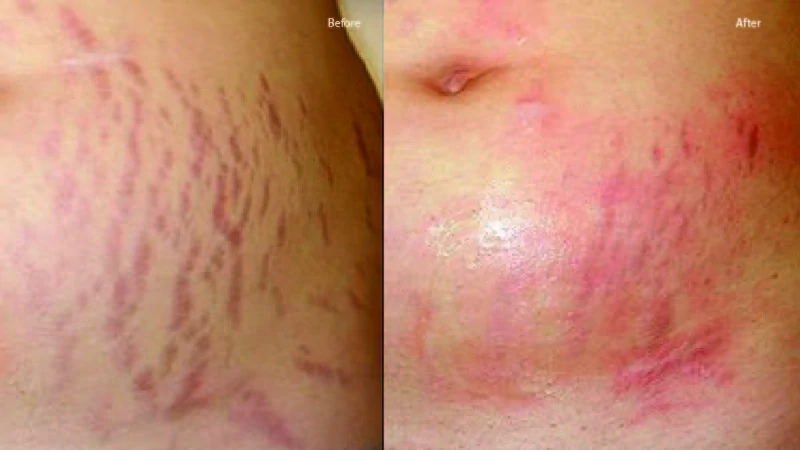 prp for stretch mark image