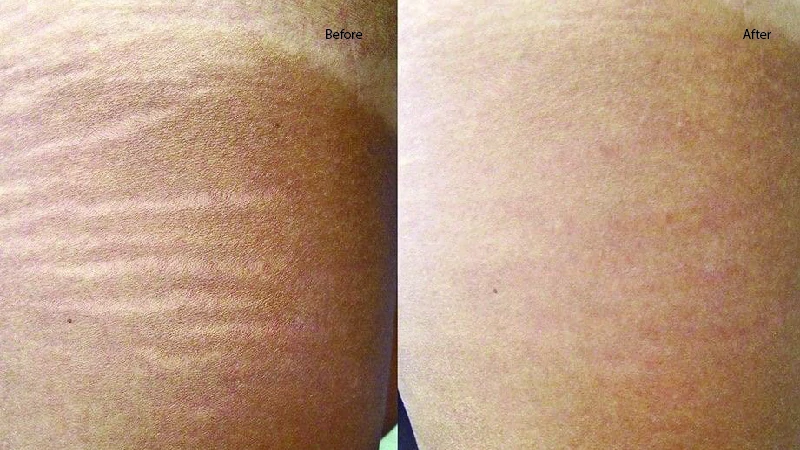 stretch mark removal