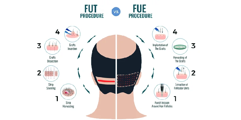 FUE v/s FUT Treatment image