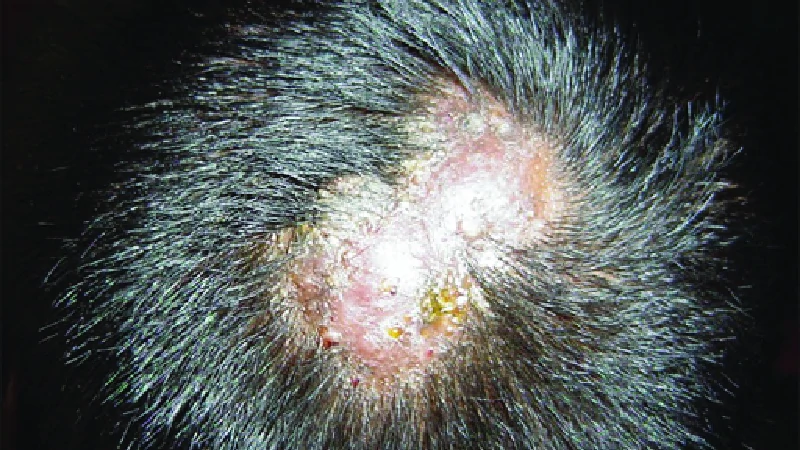 Fungal Infections image