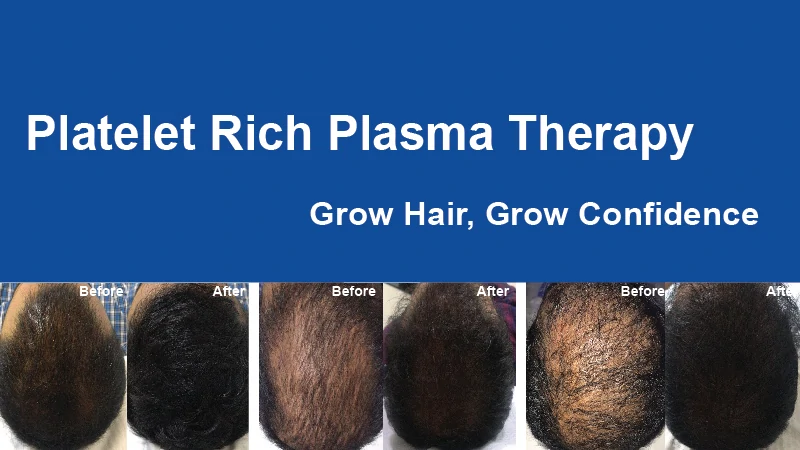 prp for hair loss in bangalore