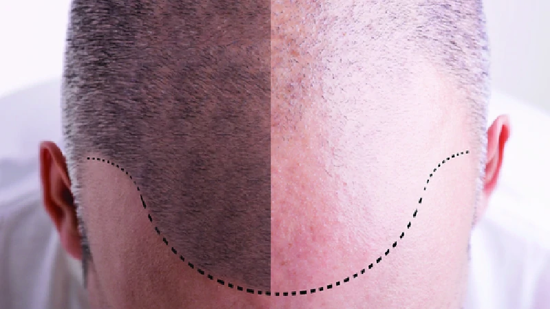 Scalp Micropigmentation image