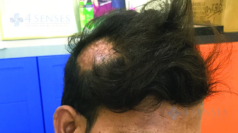 Scarring Alopecia image