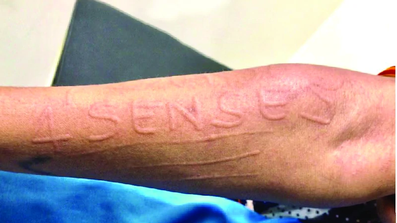 Acne Scars image