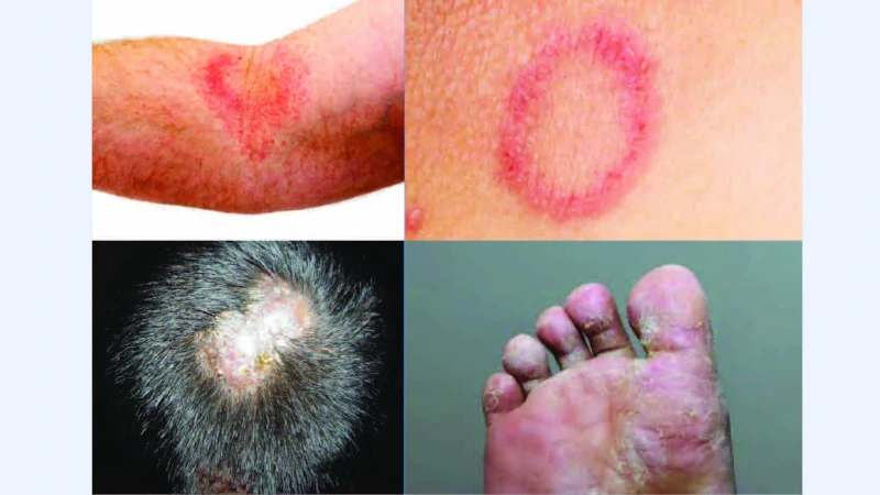 Fungal Infection image