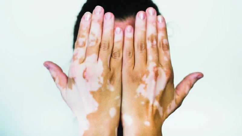 Vitiligo image