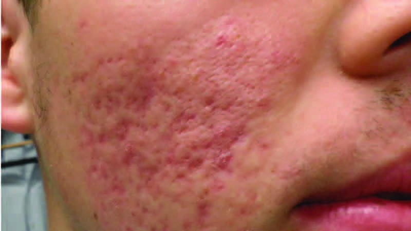 Acne Scars image