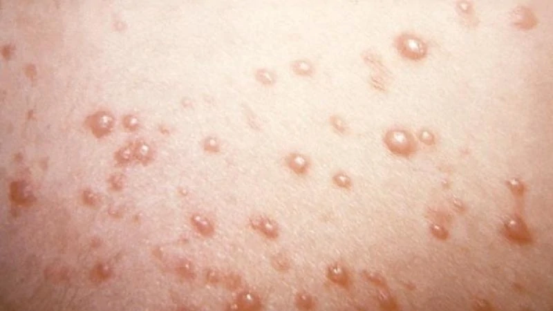 chickenpox image